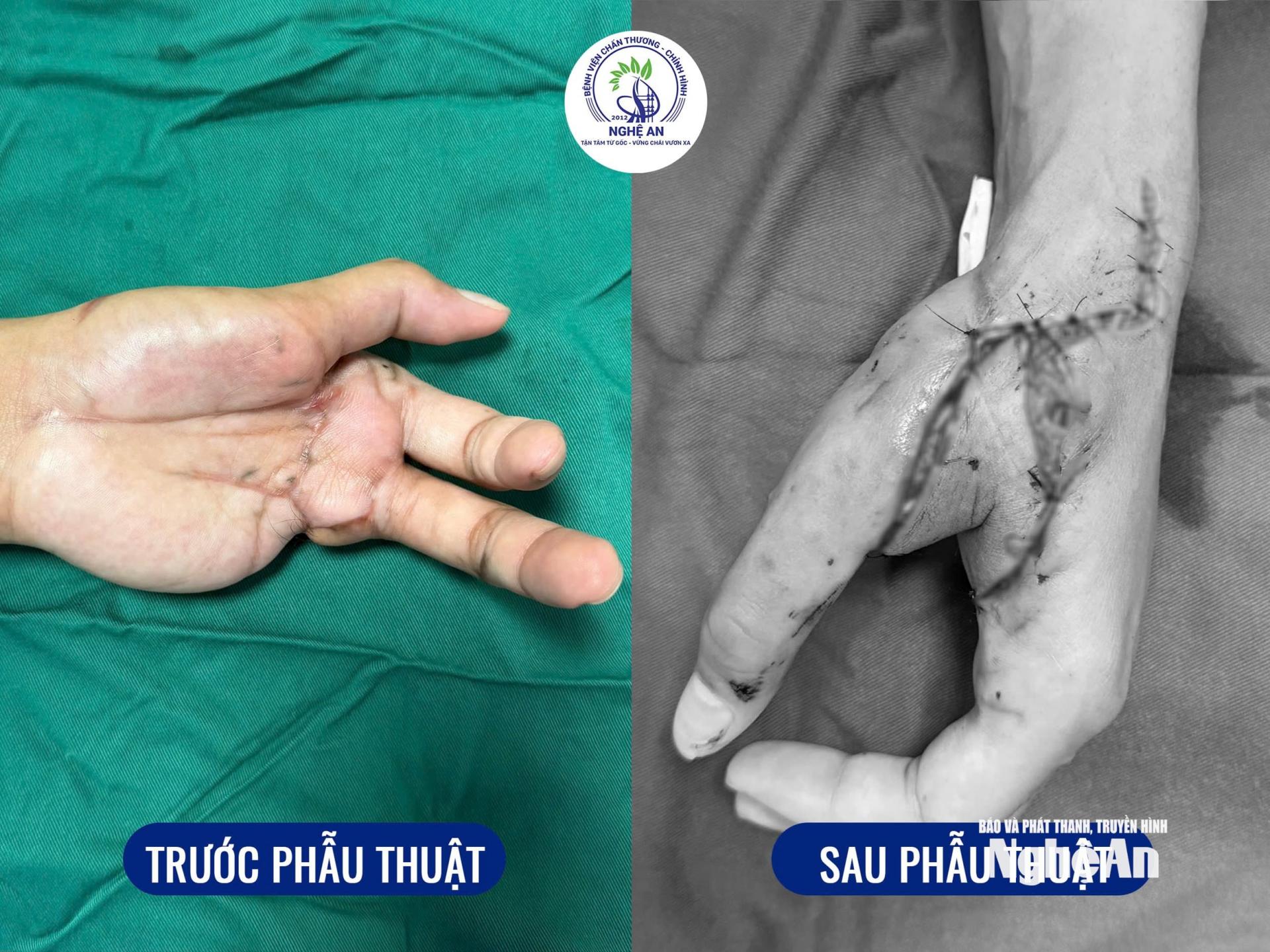 Ê-kíp các bác sĩ Bệnh viện Chấn thương - Chỉnh hình PG88 go Bắn cá thực hiện kỹ thuật chuyển vạt SCIP tự do tạo hình bàn tay. Ảnh: Đậu Huyền