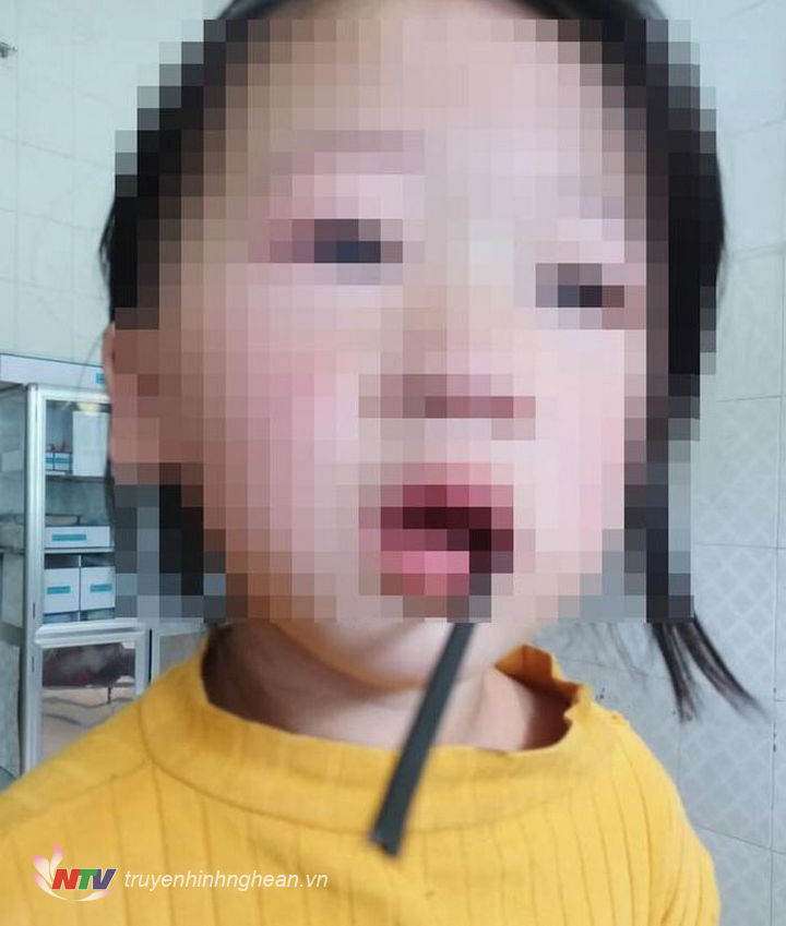 Thanh sắt đâm vào miệng cháu bé.
