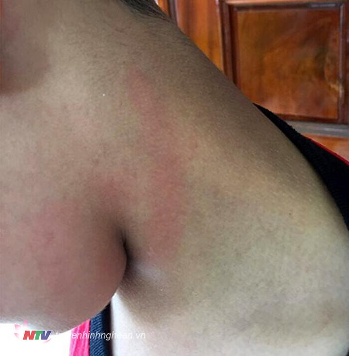 Vết đỏ trên cổ em Đ. do bị phụ huynh tên K. tát.