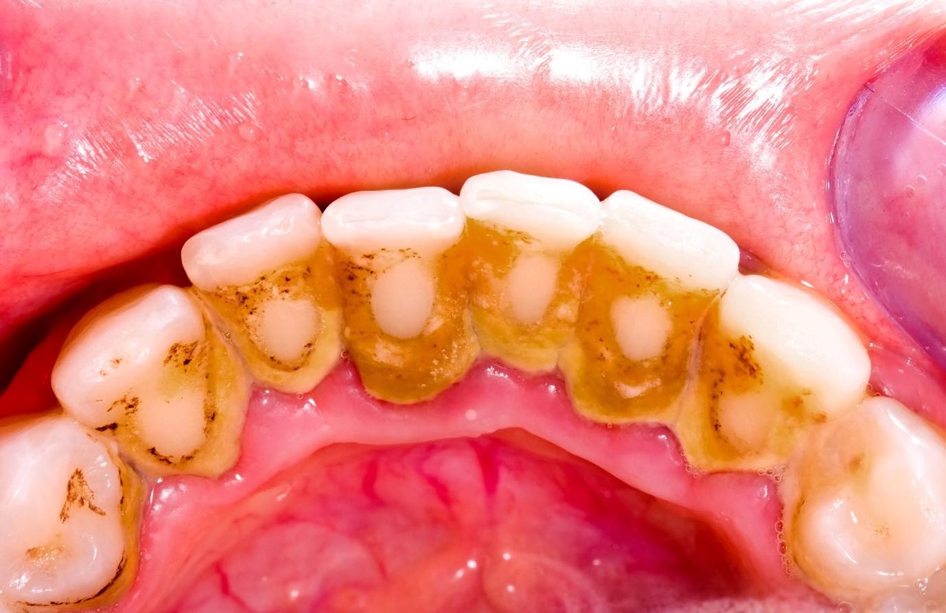 Cao răng là một trong những nguyên nhân gây bệnh ở lợi và quanh răng.