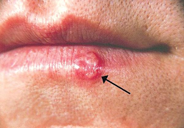 Trẻ em thường dễ bị nhiễm loại virus HSV-1 khi tiếp xúc với người lớn mang mầm bệnh