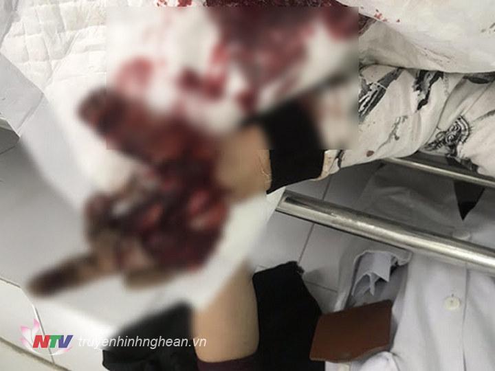 Nam sinh bị nát bàn tay do nghịch pháo