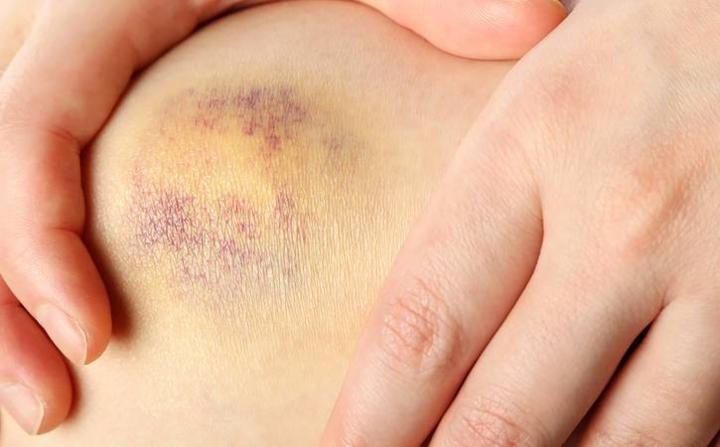 Bầm tím quá mức: Theo Trung tâm điều trị ung thư Mỹ, những vết bầm tím bất thường có thể là một triệu chứng bệnh bạch cầu.