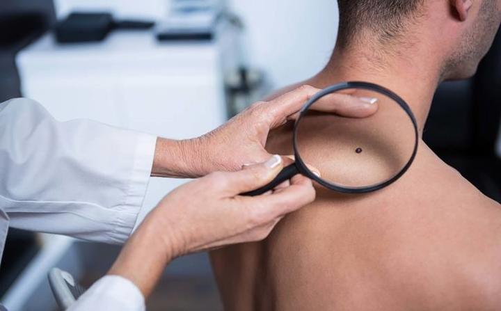 Thay đổi màu da: Khi thấy sự thay đổi trong kích thước, hình dạng, màu sắc của nốt ruồi hoặc các vết đốm lạ xuất hiện trên da, bạn hãy đi khám bác sĩ càng sớm càng tốt. Những vết đốm lạ mới xuất hiện rất có thể là dấu hiệu ban đầu của bệnh ung thư da.