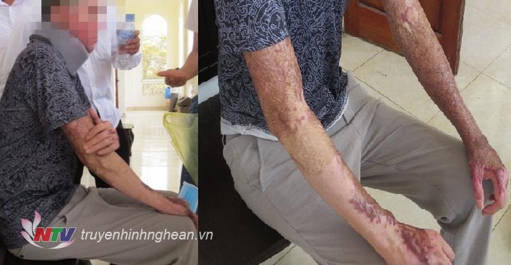 Nạn nhân bị bỏng khắp cơ thể sau sự việc trên