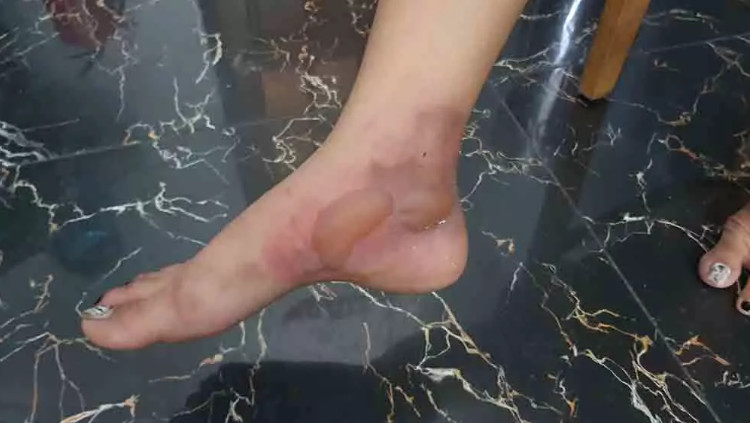 Nữ chủ quán chỉ bị bỏng nhẹ ở chân. Ảnh: T.A