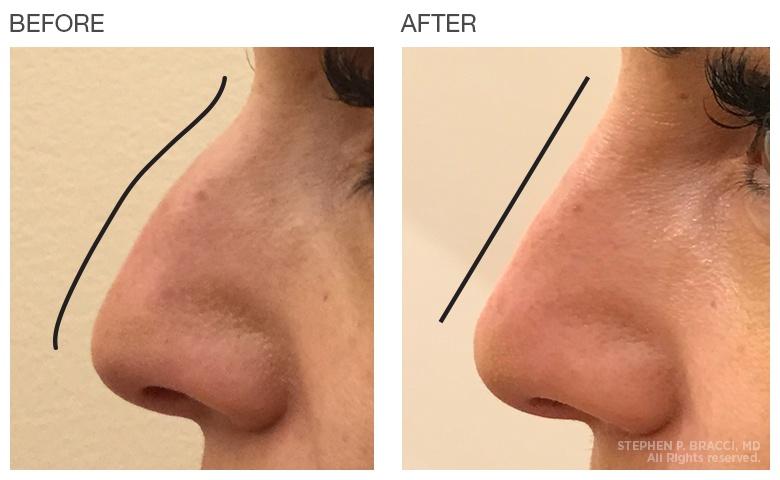 Hình ảnh trước và sau khi tiêm filler.