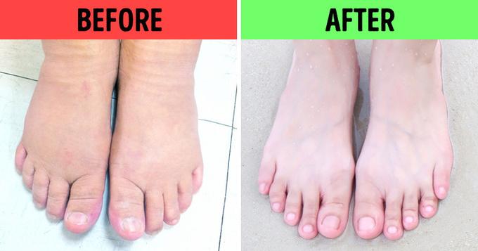 Giảm tình trạng sưng, phù nề ở chân   Chuẩn bị hai chậu nước, một nóng và một lạnh. Ngâm chân trong chậu nước nóng 10 phút rồi chuyển sang ngâm trong chậu nước lạnh thêm 10 phút nữa. Sau đó, quay lại ngâm nước nóng thêm 5 phút. Sự chênh lệch nhiệt độ sẽ giúp kích thích lưu thông máu, giảm tình trạng sưng, phù nề hiệu quả.