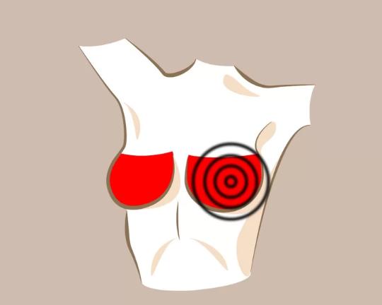 Đau tức một bên ngực  Ung thư mô vú thường không gây đau đớn nhưng ung thư vú thể viêm lại gây đau tức. Nếu thấy cơn đau kéo dài hơn một tuần, bạn nên thăm khám bác sĩ.