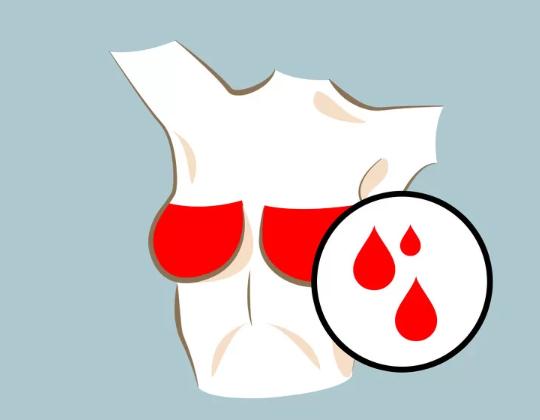 Núm vú tiết dịch Nếu không phải đang mang thai hoặc cho con bú thì tình trạng tiết dịch núm vú có thể cảnh báo những bất thường về sức khỏe. Dịch có thể không có màu hoặc có màu trắng đục, vàng, xanh lá cây, nâu hoặc thậm chí là máu. Bạn nên kiểm tra thường xuyên và thăm khám kịp thời bởi đó có thể là dấu hiệu của ung thư mô vú.