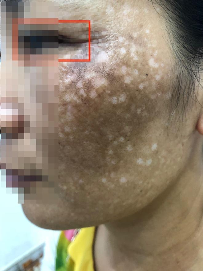 Tình trạng nám má của bệnh nhân khi nhập viện. Ảnh: BSCC