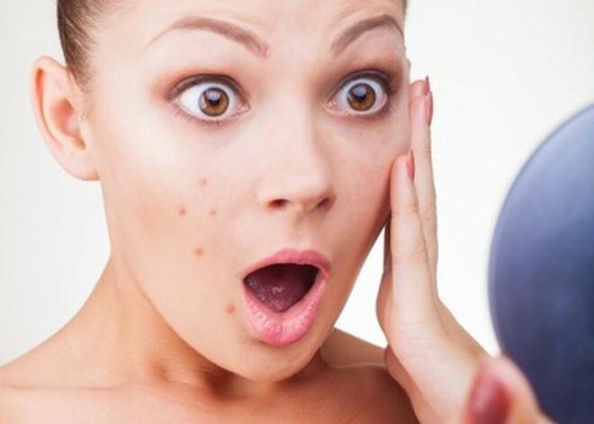 Da nổi mụn do bị kích ứng với thành phần không phù hợp trong kem dưỡng ẩm.