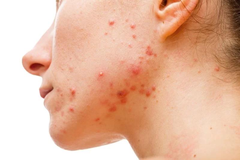Mụn: Dầu dừa được cho là có hiệu quả trong điều trị mụn nhờ có các thành phần kháng khuẩn, nhưng điều này chỉ đúng với da khô hoặc da thường. Sử dụng dầu dừa cho da dầu chỉ khiến tình trạng mụn nhọt tệ hơn.