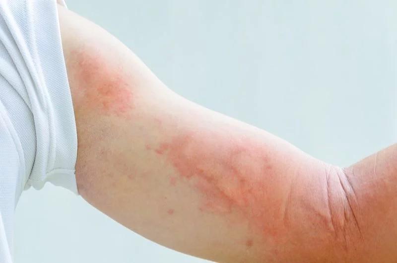 Dị ứng: Những người bị dị ứng với dầu dừa cần tránh sử dụng bất kỳ sản phẩm nào có chứa dầu dừa. Dị ứng dầu dừa có thể gây mẩn ngứa, buồn nôn, nôn mửa, thậm chí sốc phản vệ hoặc tim đập nhanh.
