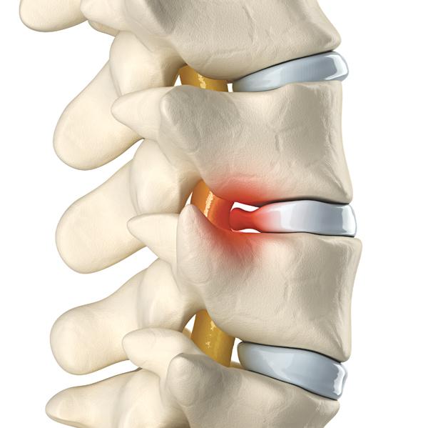 Biến chứng do chèn ép rễ thần kinh.