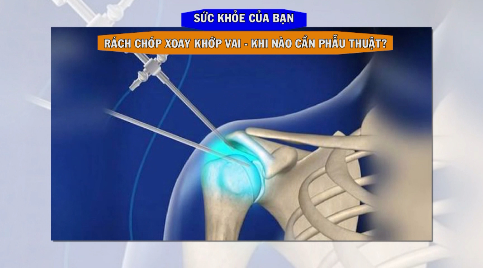 [🔴Trực tiếp] Sức khỏe của bạn: Rách chóp xoay khớp vai - Khi nào cần phẫu thuật?