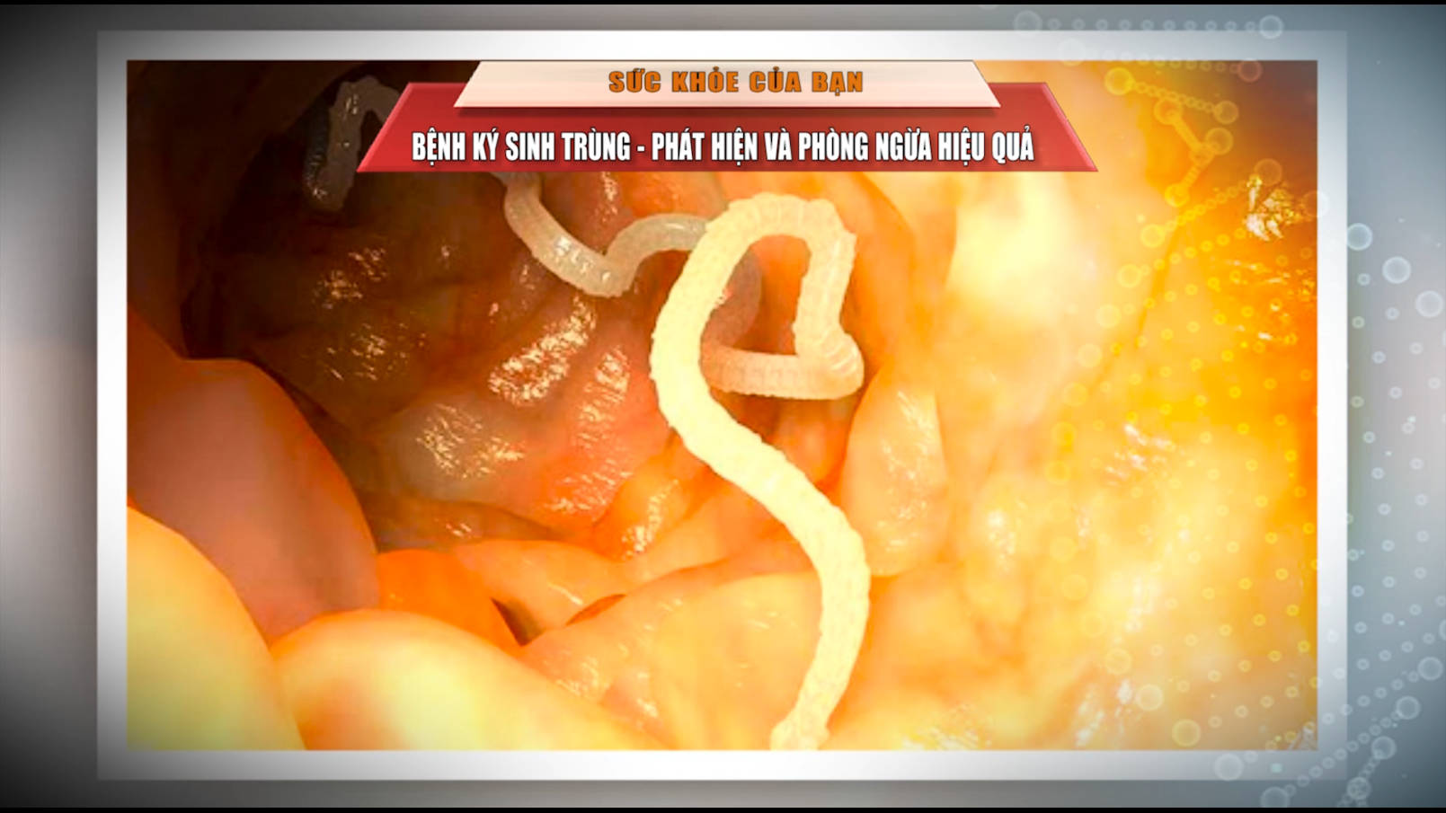 [🔴Trực tiếp] Sức khỏe của bạn: Bệnh ký sinh trùng - Phát hiện và phòng ngừa hiệu quả